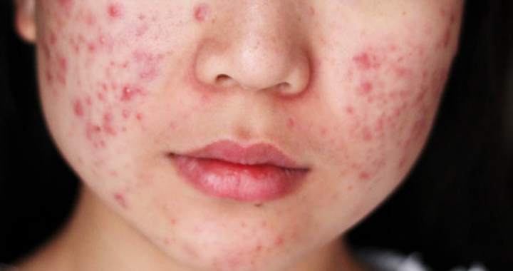 Understanding The Formation Of Acne – Dr Chloe Ho